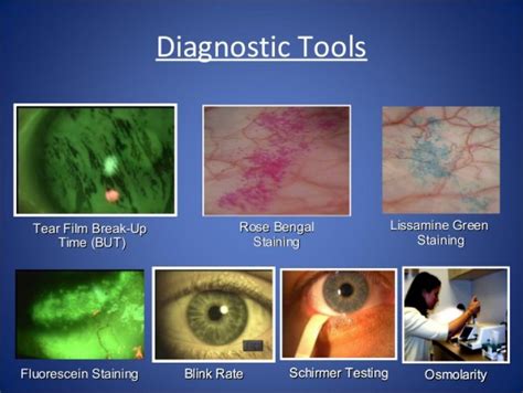 tear breakup test|diagnostic test for dry eyes.